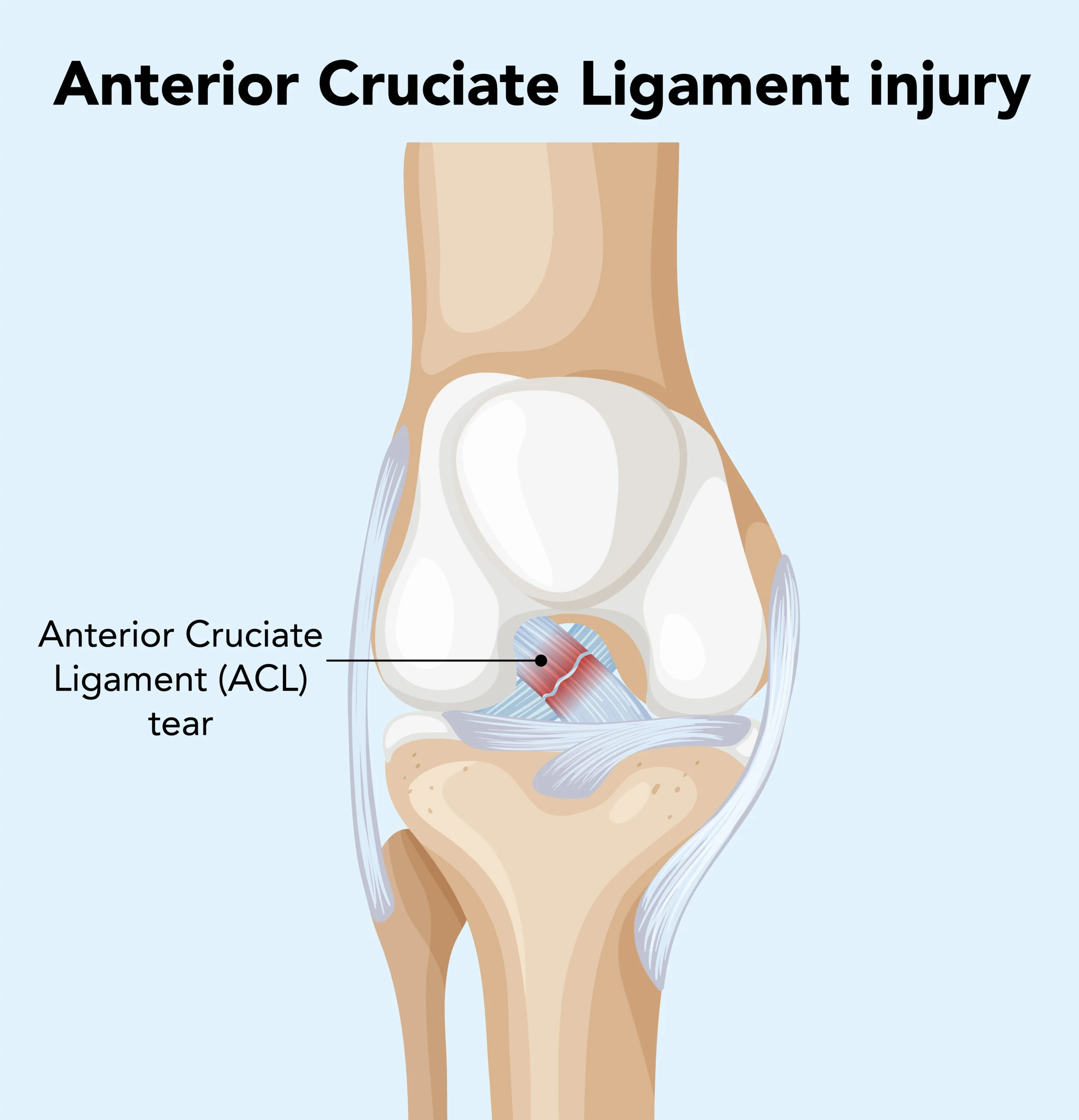 Anterior Cruciate Ligament Injury