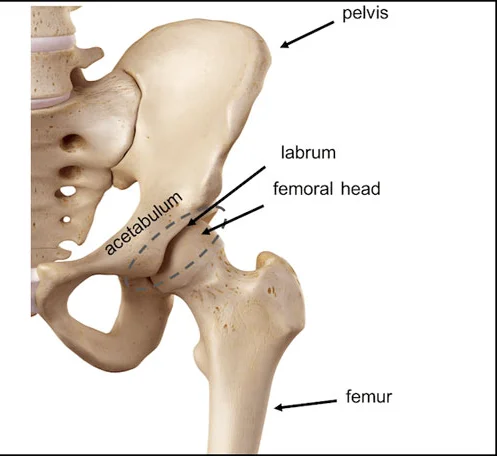 Clinical Identification of AVN Hip Progress