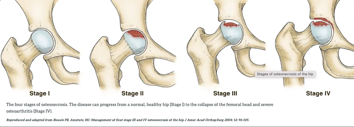 Symptomatic Limitation of Pelvic Mobility