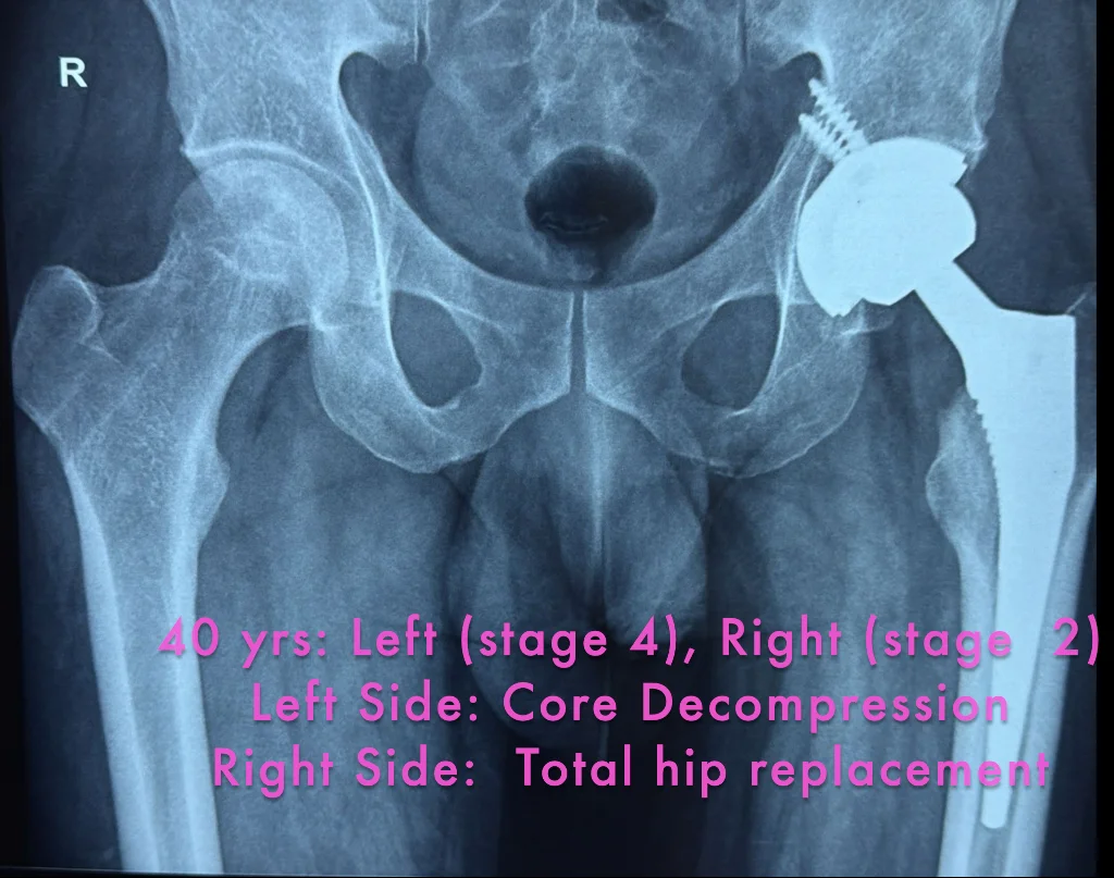 Hip Preservation Surgical Modality Application