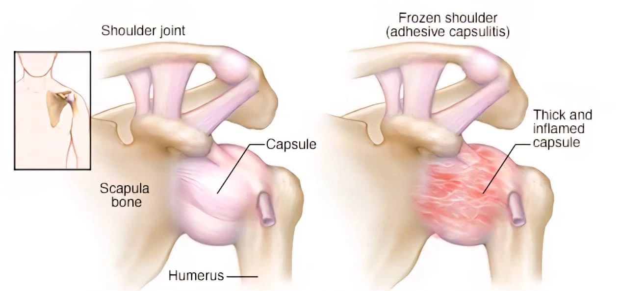 Anatomical structural difference of normal vs inflamed capsule