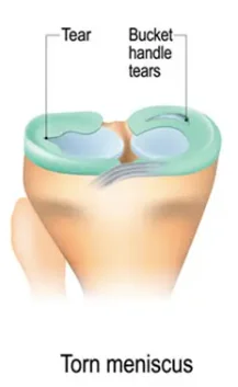 Torn Meniscus Diagram
