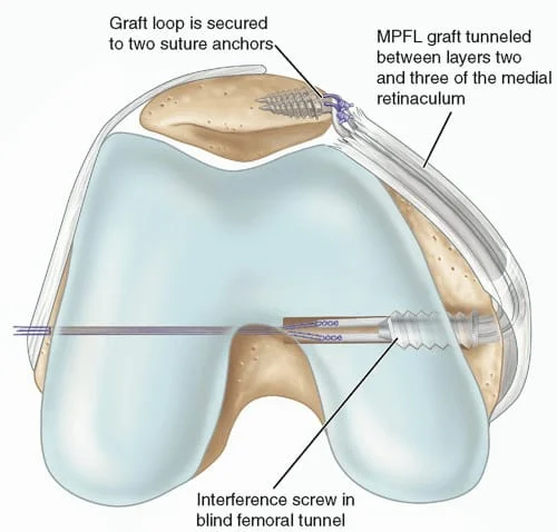 Torn MPFL Diagram