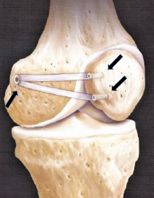 Flat Trochlea Radiograph X-Ray