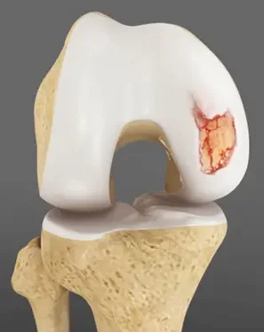 Osteochondritis Dissecans Joint Anomaly