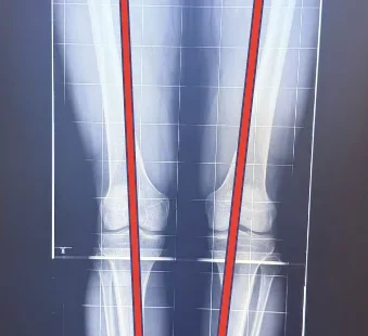 High Tibial Osteotomy