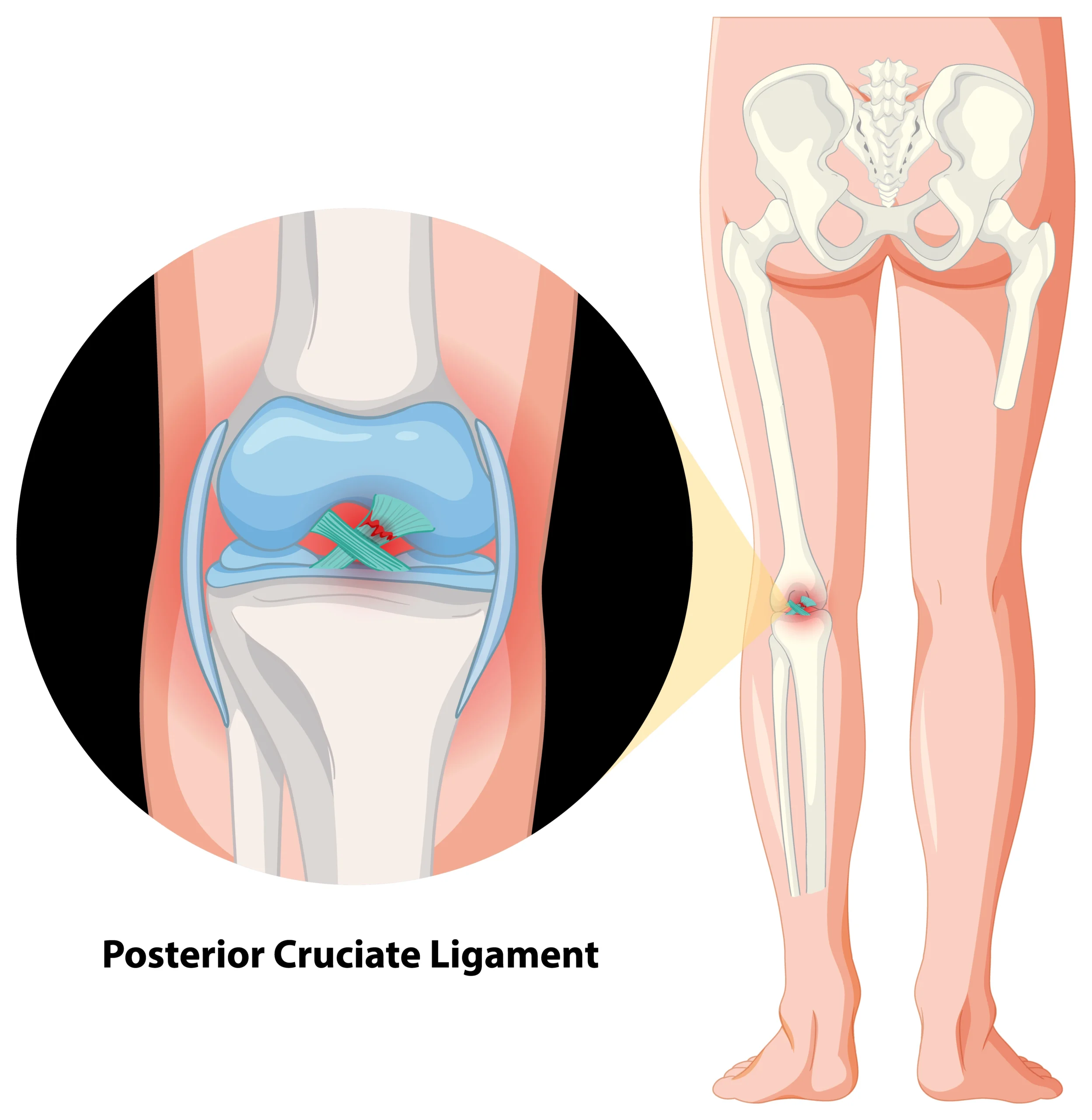 PCL Medical Illustration