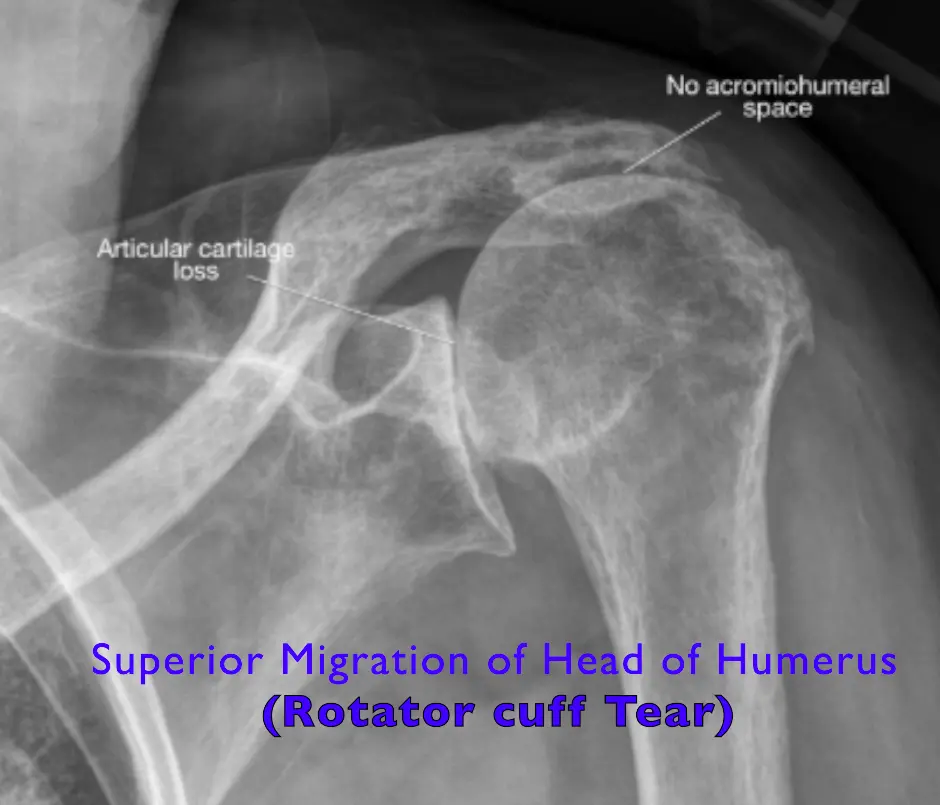 Clinical Identification of Shoulder Mechanics