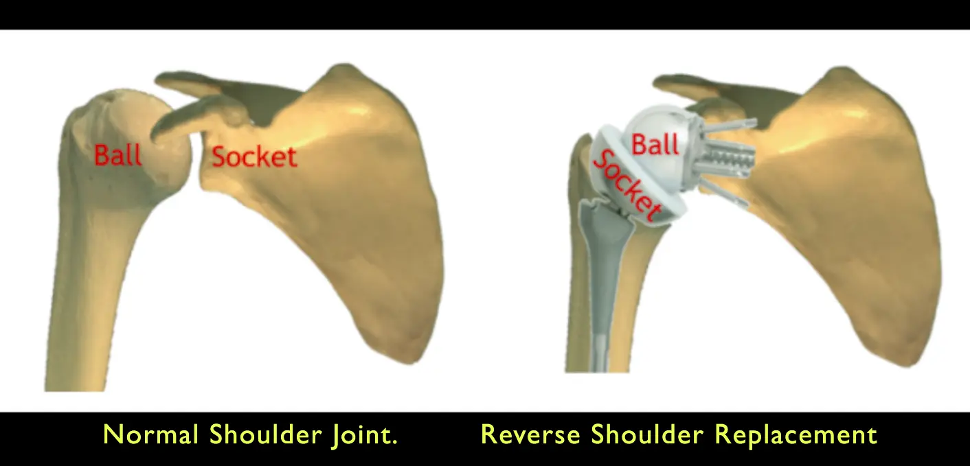 Anatomical Profile of Reverse Shoulder Components