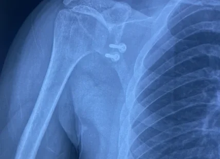 Arthroscopic View of Shoulder Labrum Repair