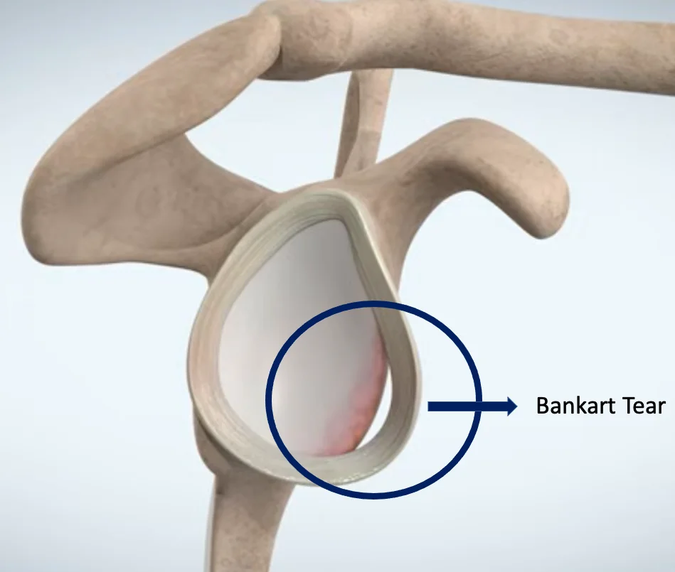 Post-Operative Shoulder Physical Rehabilitation Exercises