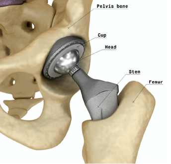 Total Hip Replacement Main Interface Visual