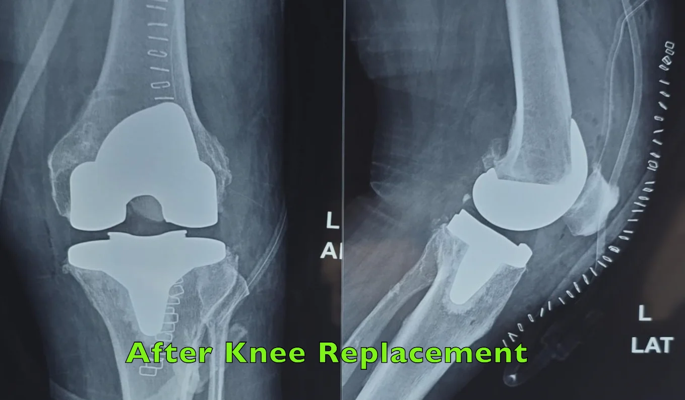 Structural Architecture of a Knee Prosthetic