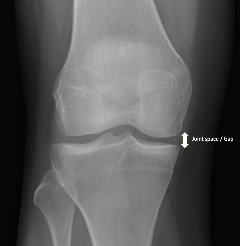 Clinical Evaluation of Knee Alignment