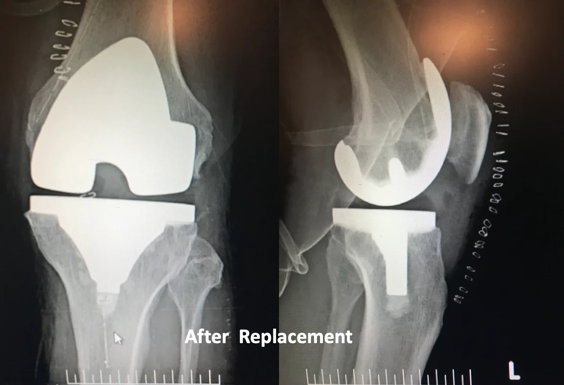 Total Knee Replacement Precision Visual