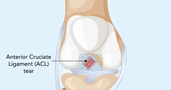 ACL - Dr Manish Aroraa