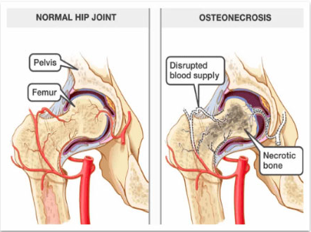 AVN Hip Dr Manish Arora 2