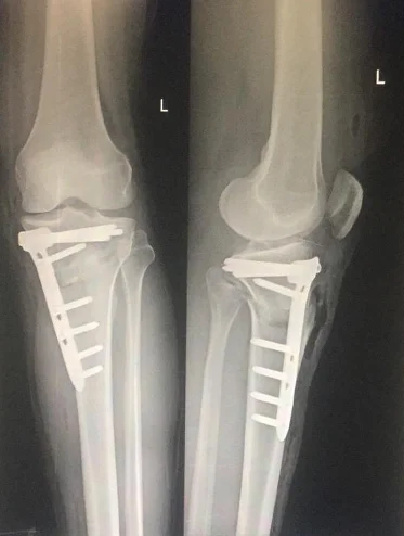 High Tibial Osteotomy Dr Manish Aroraa