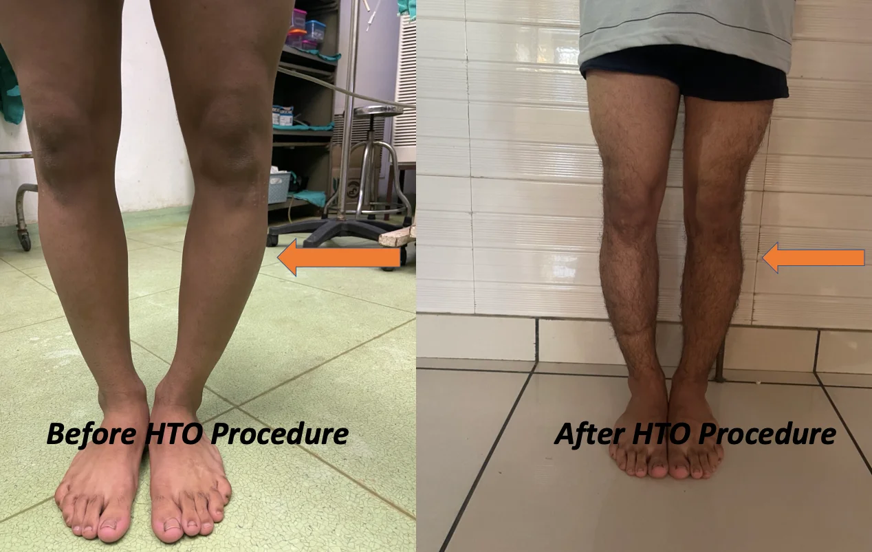 High Tibial Osteotomy Dr Manish Aroraa