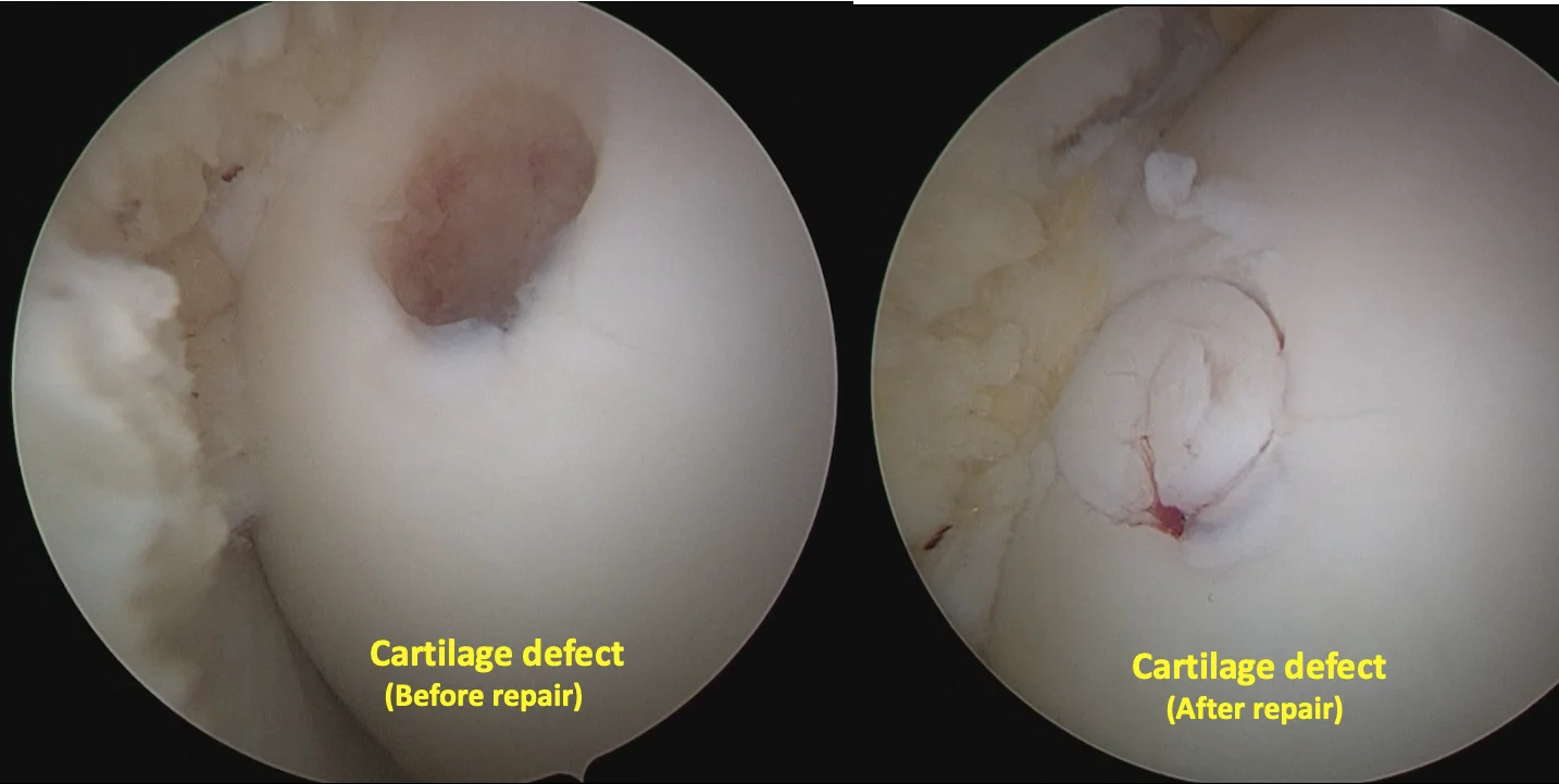Knee Joint Cartilag Defects Dr Manish Aroraa