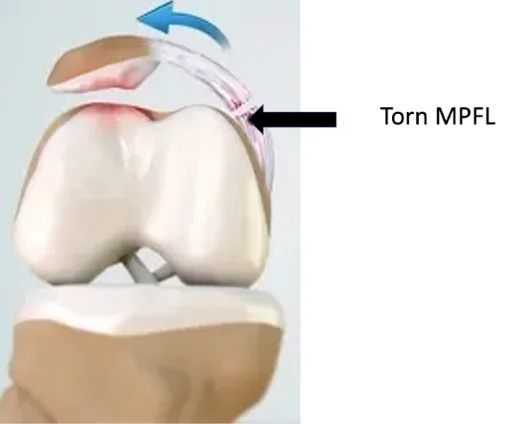 Lateral Recurrent Patella Dislocation Dr Manish Aroraa