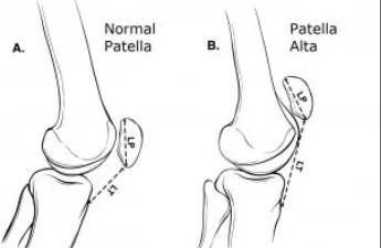 Lateral Recurrent Patella Dislocation Dr Manish Aroraa 3