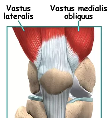Lateral Recurrent Patella Dislocation Dr Manish Aroraa