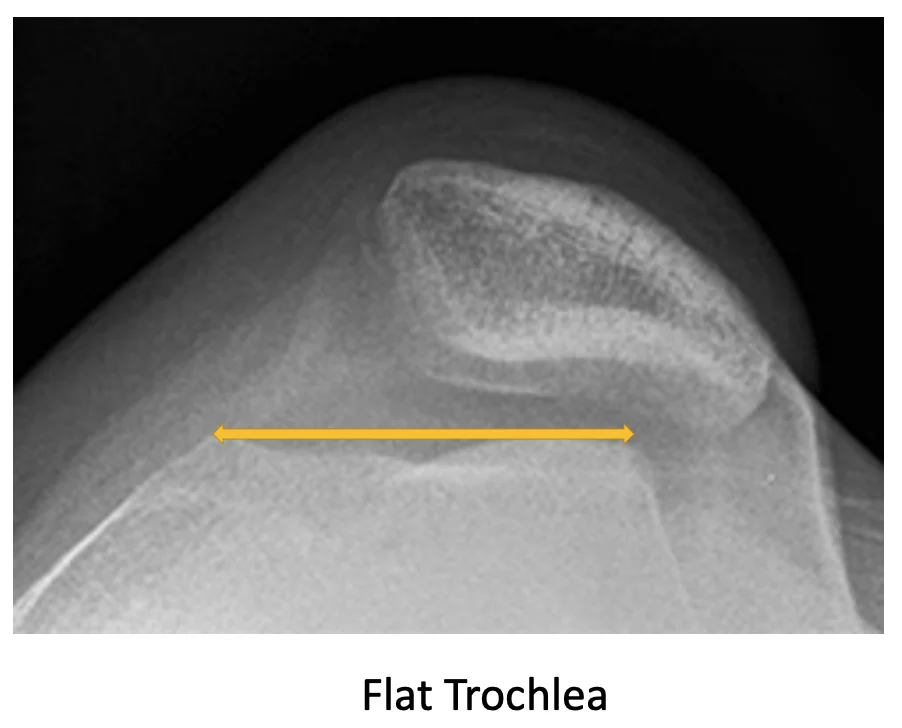 Lateral Recurrent Patella Dislocation Dr Manish Aroraa