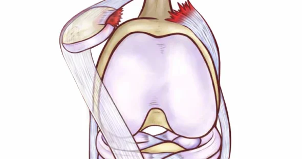 Lateral Recurrent Patella Dislocation