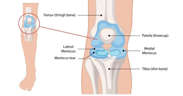 Meniscus Tear Dr Manish Aroraa