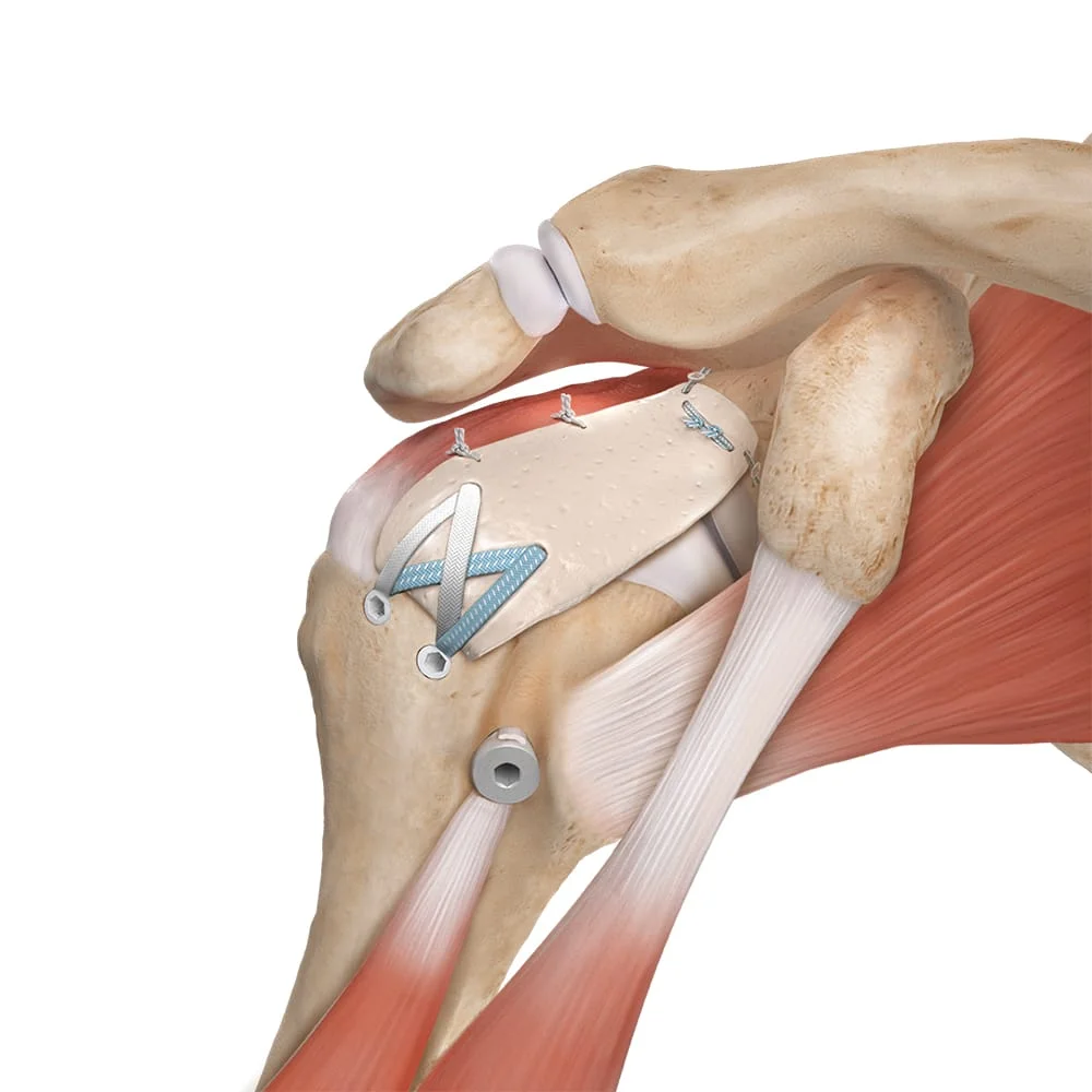 Rotator Cuff Tear Dr Manish Aroraa
