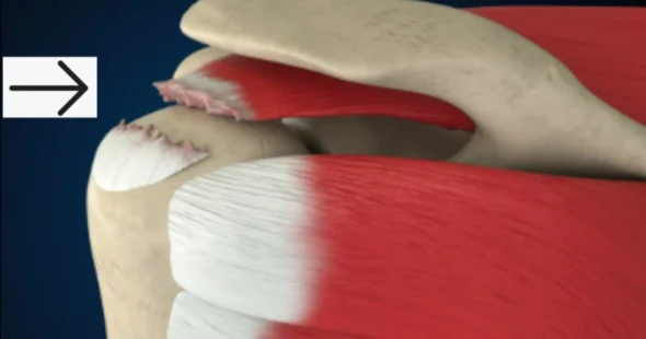 Rotator Cuff Tear