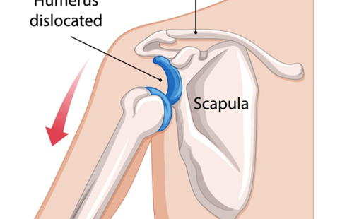 Shoulder Dislocation