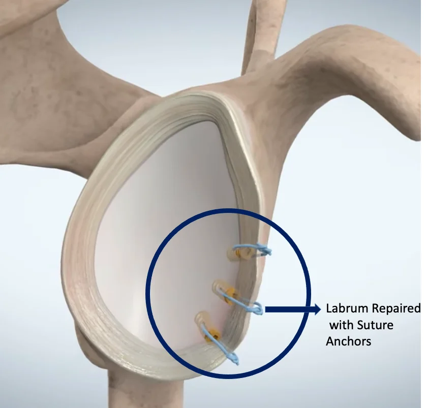 Shoulder Dislocation Dr Manish Aroraa