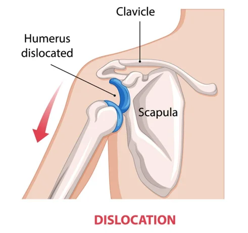 Shoulder Dislocation Dr Manish Aroraa