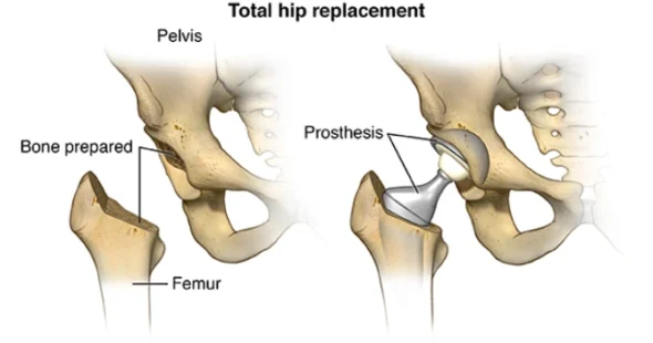 Total HIP Replacement - Dr Manish Aroraa 3