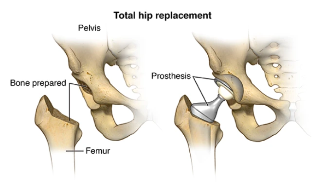 Total HIP Replacement - Dr Manish Aroraa 3