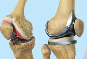 Total Knee Replacement TKR Dr Manish Aroraa 1