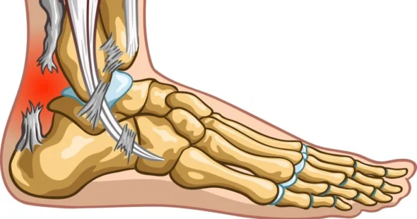 achilles tendon tear - Dr Manish Aroraa